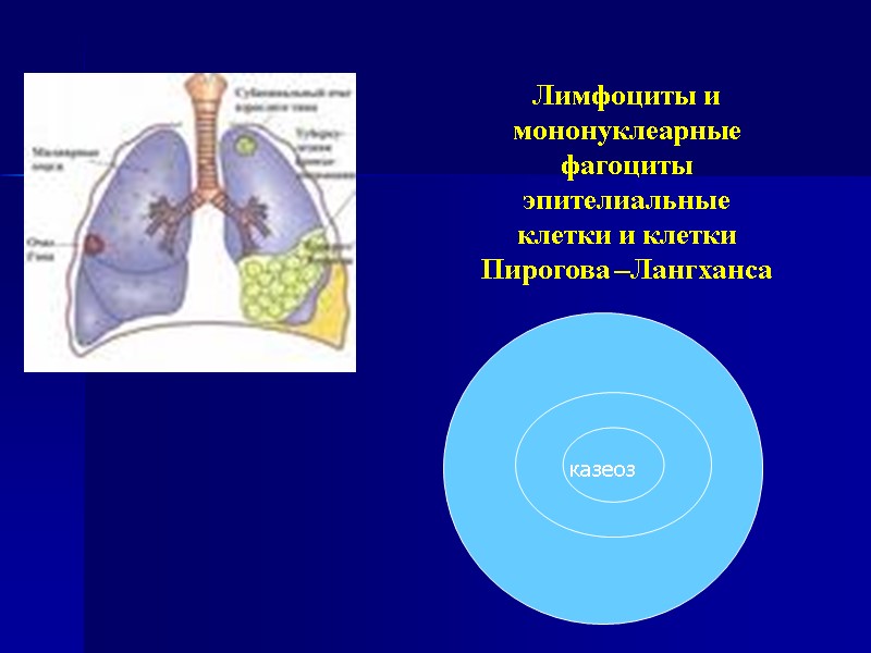 казеоз       Лимфоциты и мононуклеарные фагоциты эпителиальные  клетки